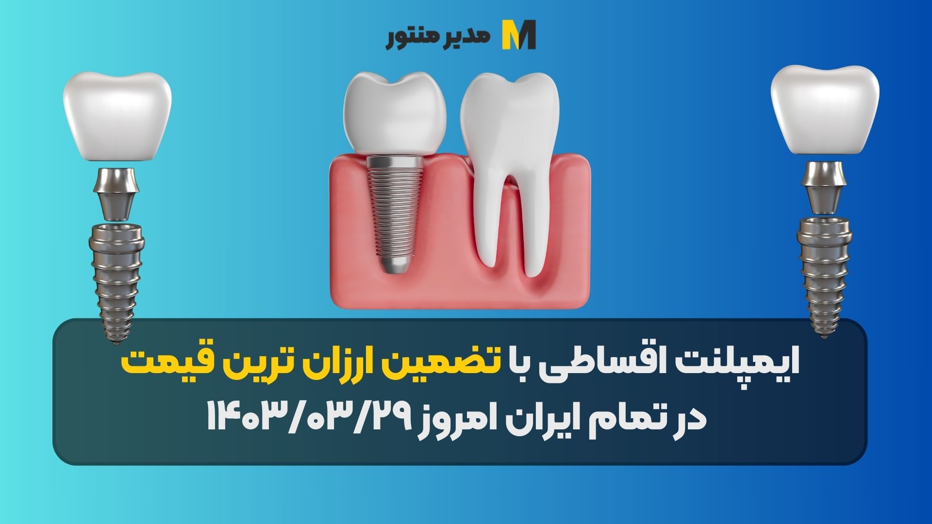 ایمپلنت اقساطی با تضمین ارزان ترین قیمت در تمام ایران امروز ۱۴۰۳/۰۳/۲۹