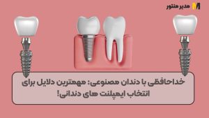 خداحافظی با دندان مصنوعی مهمترین دلایل برای انتخاب ایمپلنت های دندانی!