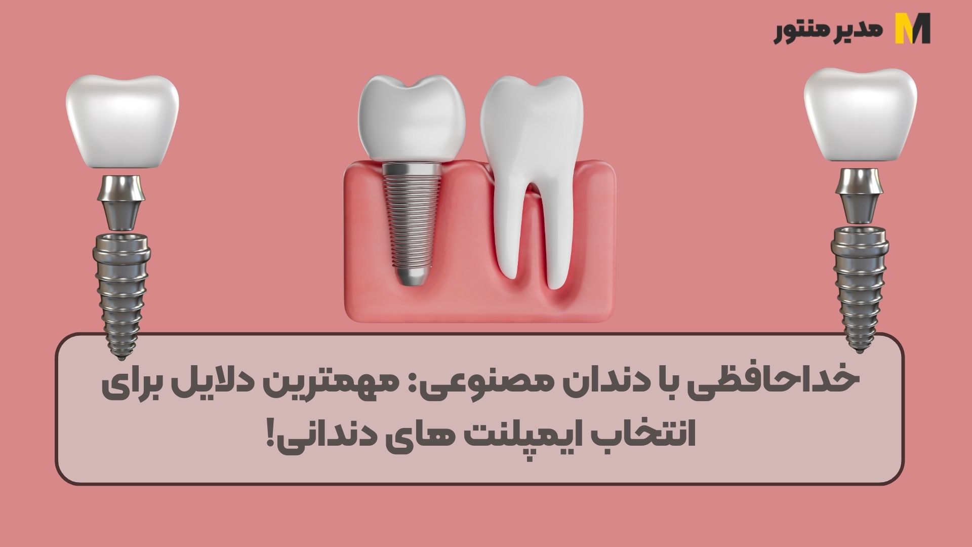 خداحافظی با دندان مصنوعی مهمترین دلایل برای انتخاب ایمپلنت های دندانی!